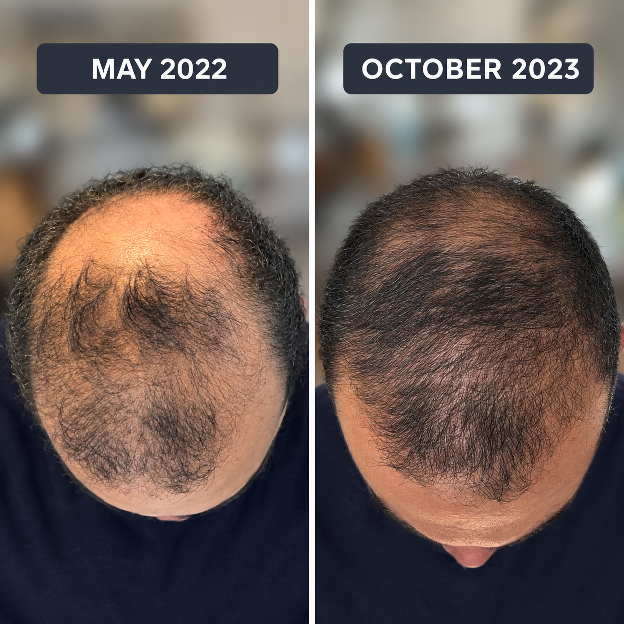 Top-down photos of the same scalp seventeen months apart, May 2022 and October 2023, showing visible regrowth across the crown and hairline